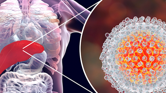 Chronic Hepatitis C: A Multifaceted Disease | Harvard University